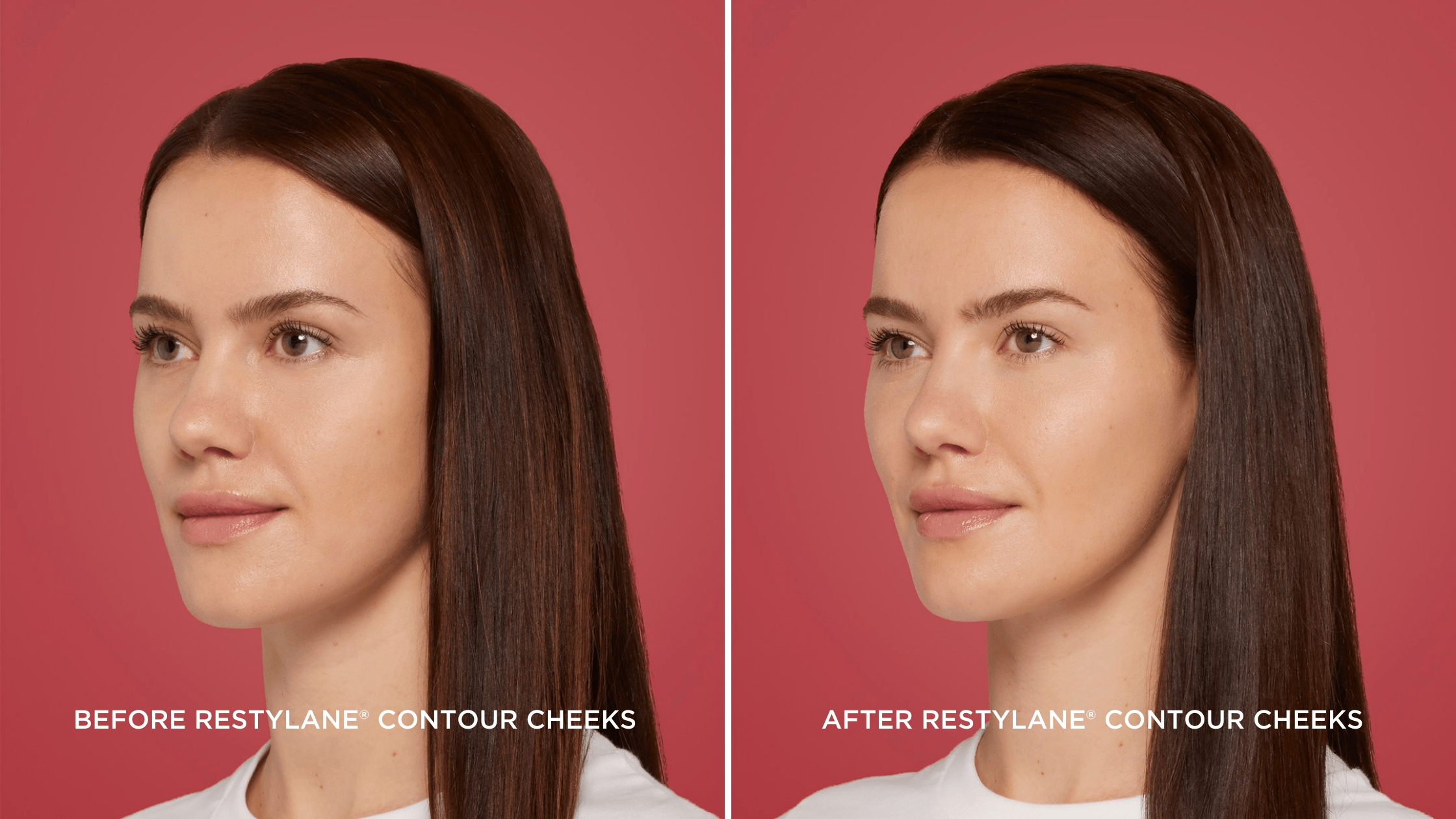 Before and After Restylane