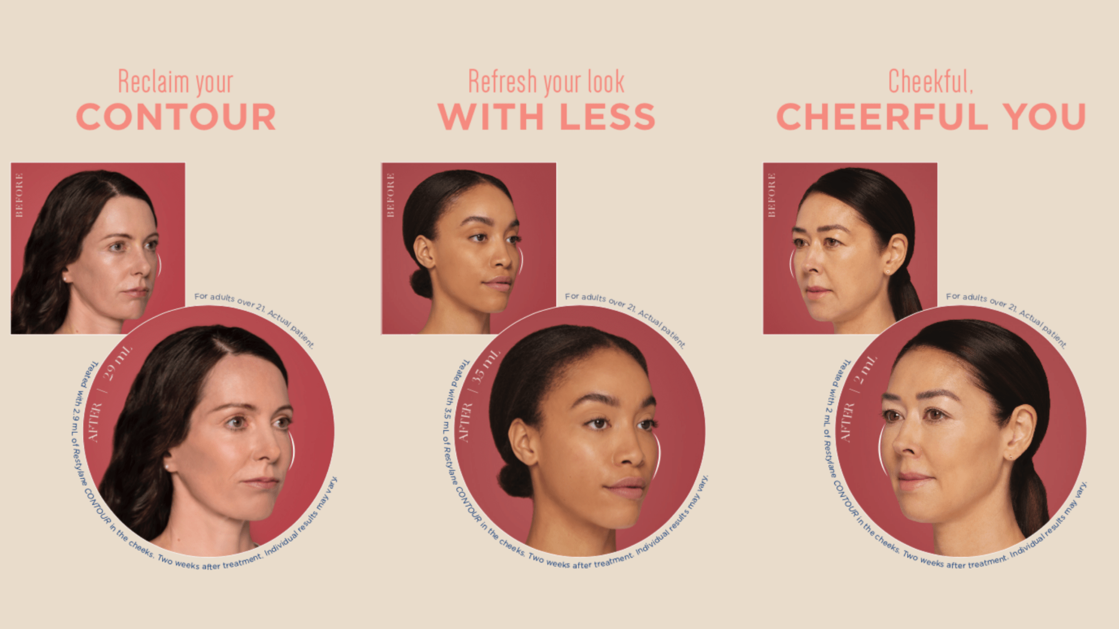 Restylane Contour