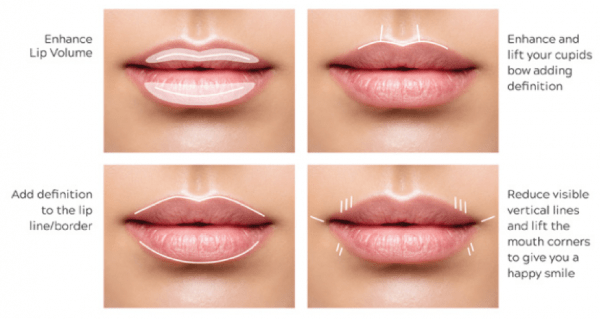 LipFillerAreas